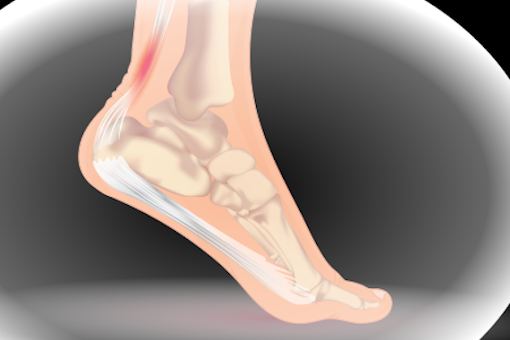 Achilles tendinitis